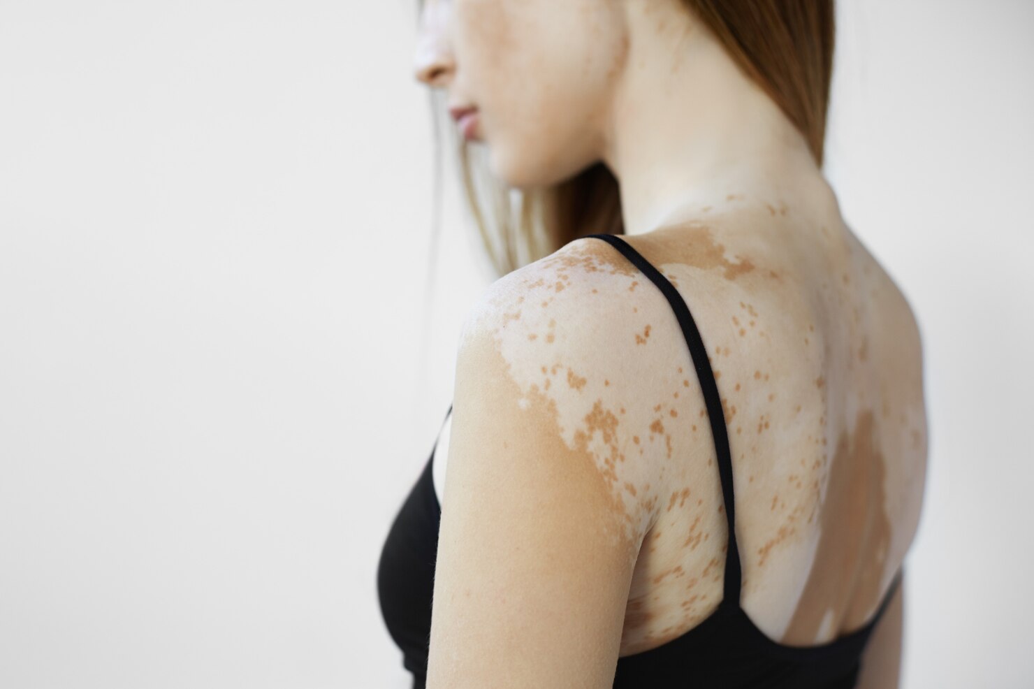 Vitiligo Camouflage Treatment