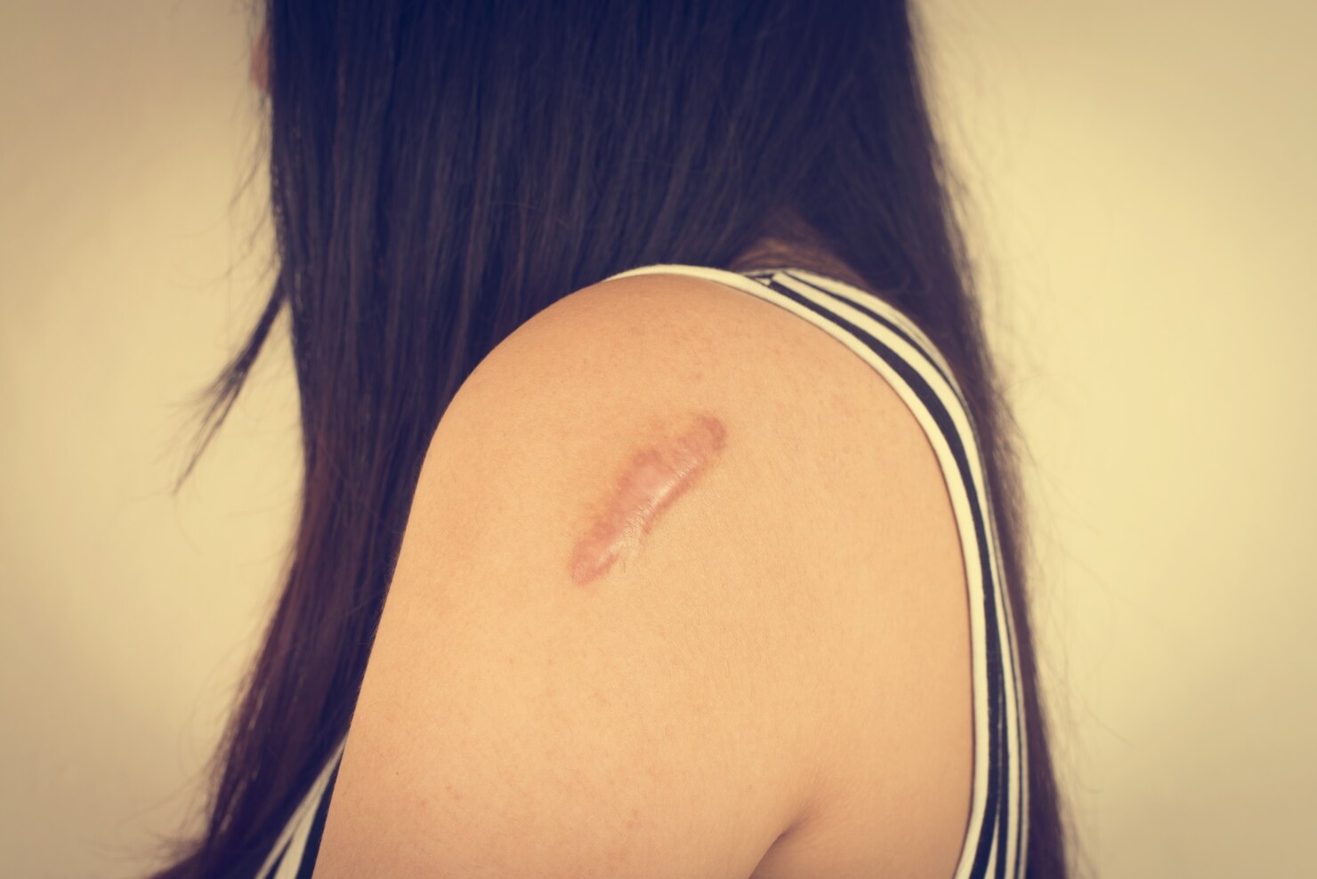 Scar Camouflage Result